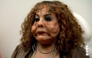 Face Injected With Cement