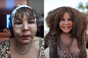 Face Injected With Cement