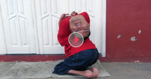 Man Who Lives With Extraordinary Disability