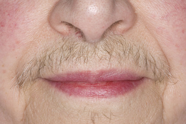 Easy Recipes for Getting Rid of Facial Hair at Home