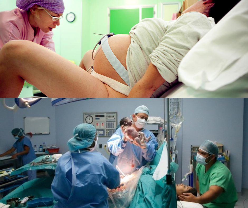 Facts About C-Sections