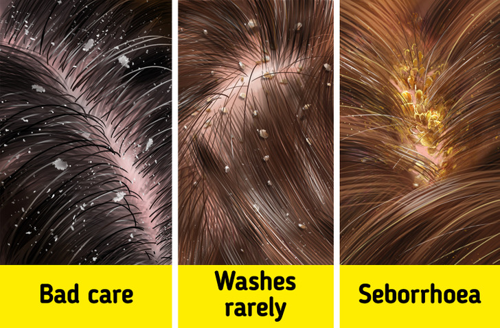  get rid of dandruff and the treatment methods used