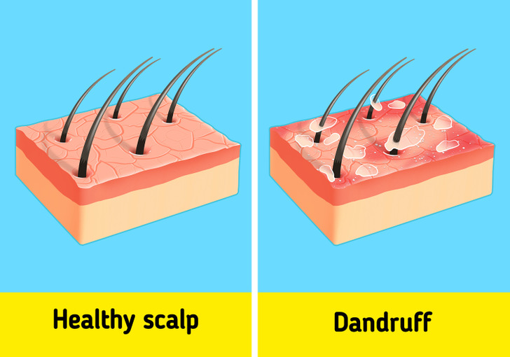  get rid of dandruff and the treatment methods used