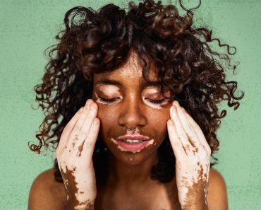 Deciphering Vitiligo Unraveling Skin Depigmentation Mechanisms