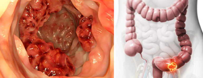Colon Cancer Cells